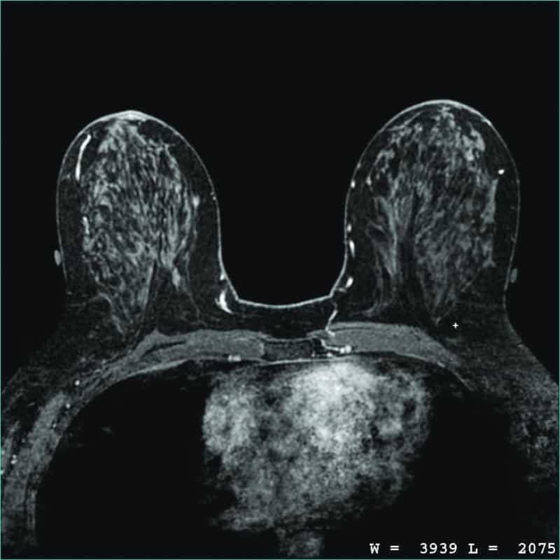 Breast MRI from Insight Medical Imaging, Alberta