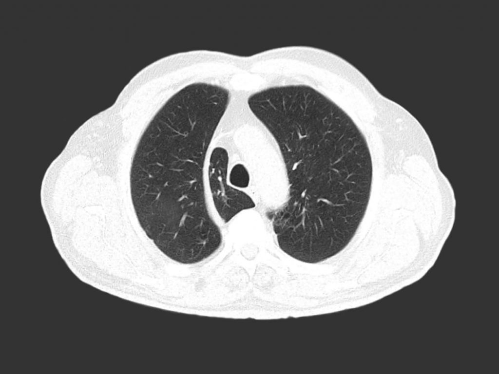 Chest computed tomography scan in Alberta