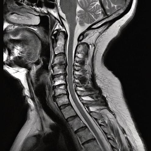 Edmonton Spine MRI