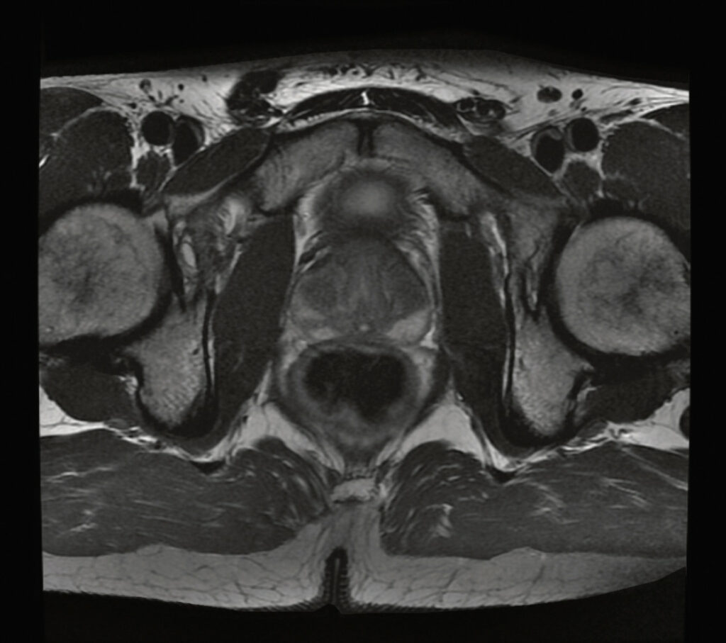 Magnetic resonance imaging, pelvic region testing
