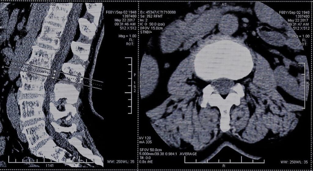 Spine computed tomography scan