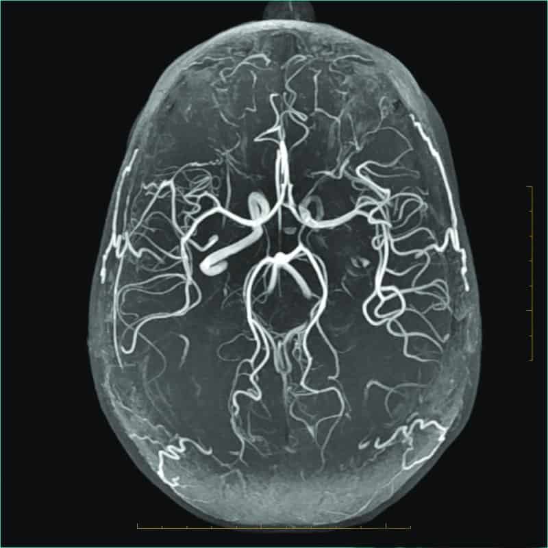 mri angiography Edmonton