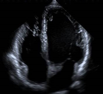 Echocardiogram in Edmonton, Alberta for heart ultrasound scans