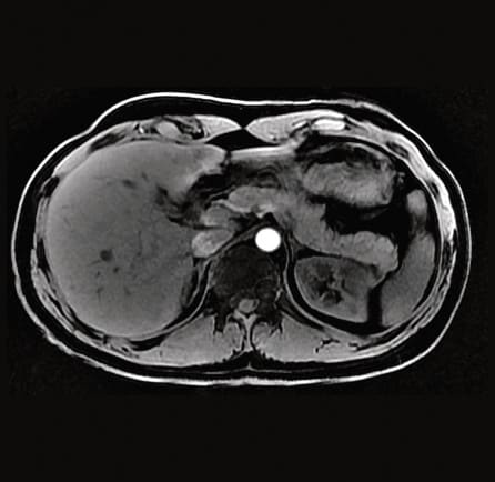 MRI of abdomen