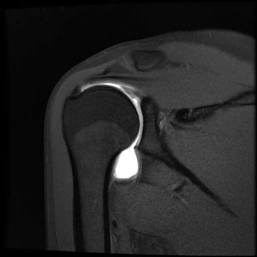 MRI arthrogram