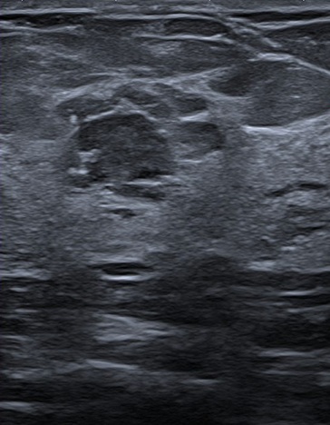 Breast-ultrasound