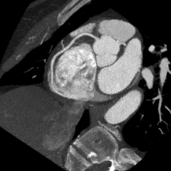Coronary Angiogram CT Scans