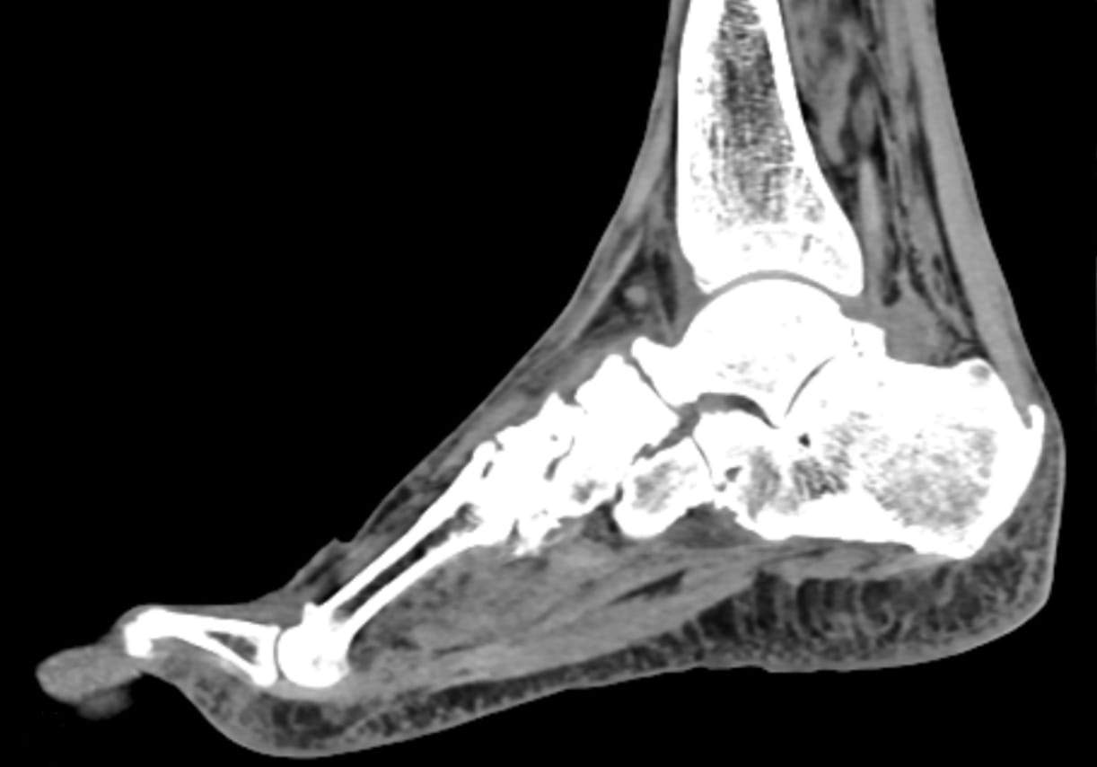 Extremity CT Scans