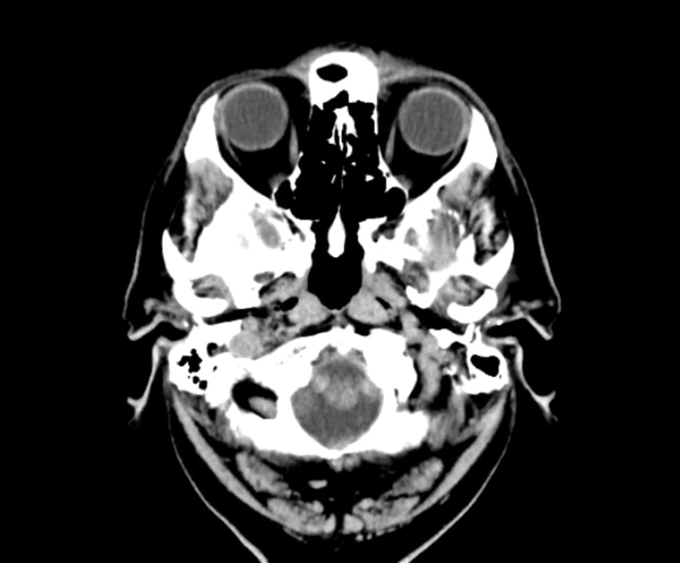 Head CT Scans Alberta