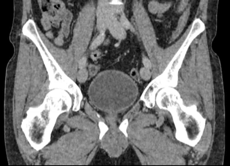 Pelvic CT Scans Edmonton