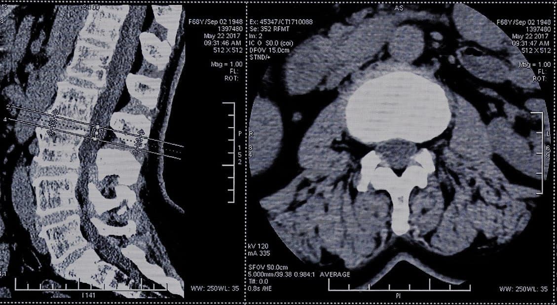 Cervical, Lumbar, and Thoracic Spine CT Scans