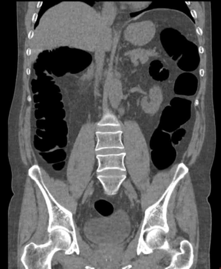 Virtual Colonoscopy CT Scans Edmonton