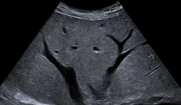 Abdominal ultrasound imaging scan