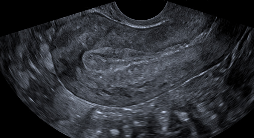 Pelvic ultrasound Alberta