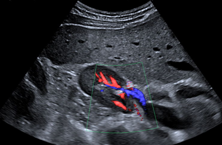 renal-ultrasound