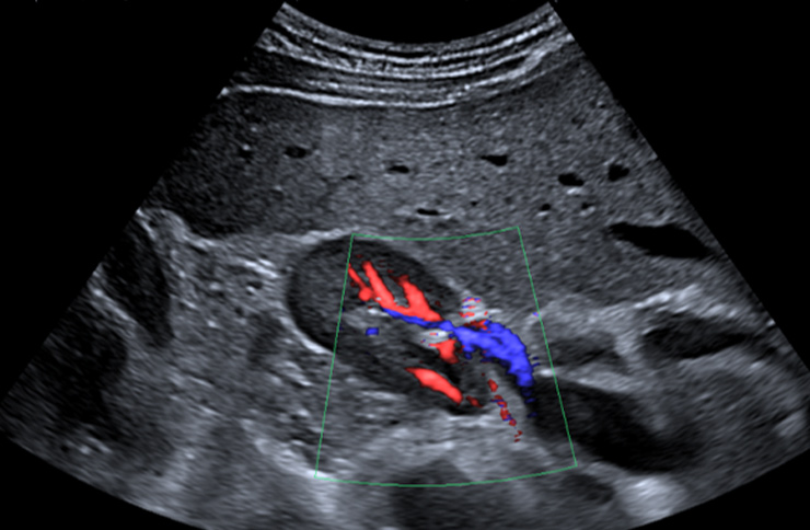 renal sonogram