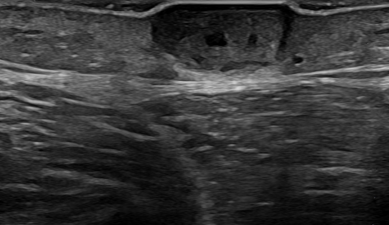 Soft Tissues Sonography Frontal Area Lesion Clinical Report Video | My ...