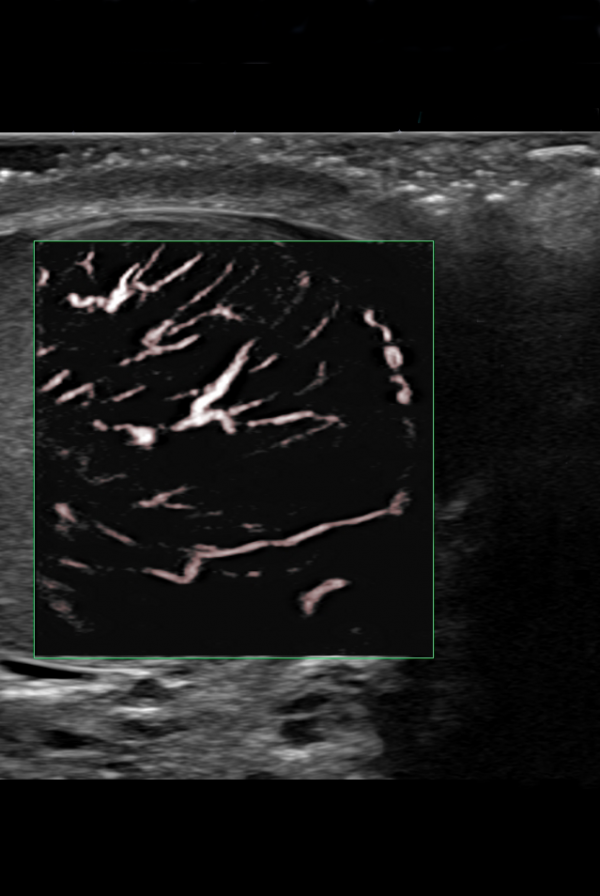 Testicular Ultrasound - Insight Medical Imaging