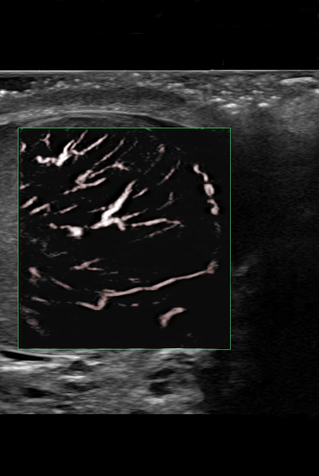 testicular-ultrasound-perfusion