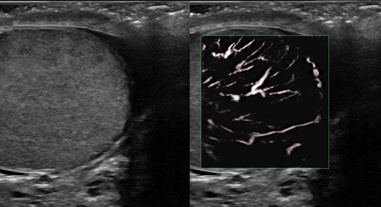 Scrotal Anatomy Ultrasound