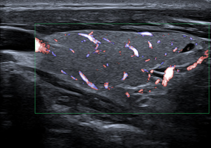 Thyroid-ultrasound alberta