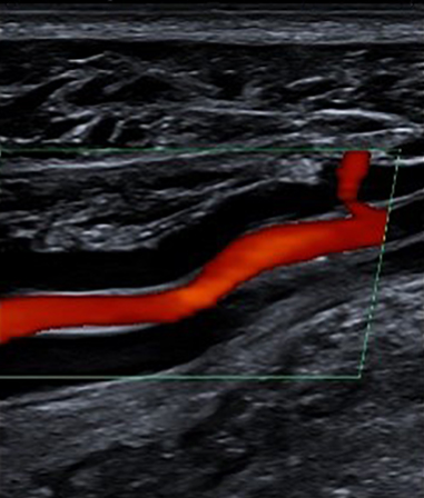 Vascular-ultrasound