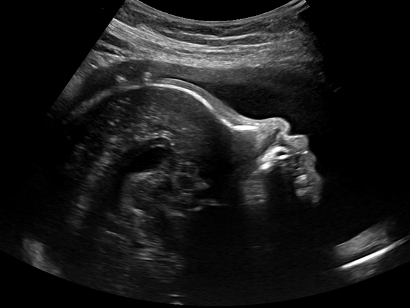 Pregnancy obstetric ultrasound in Edmonton