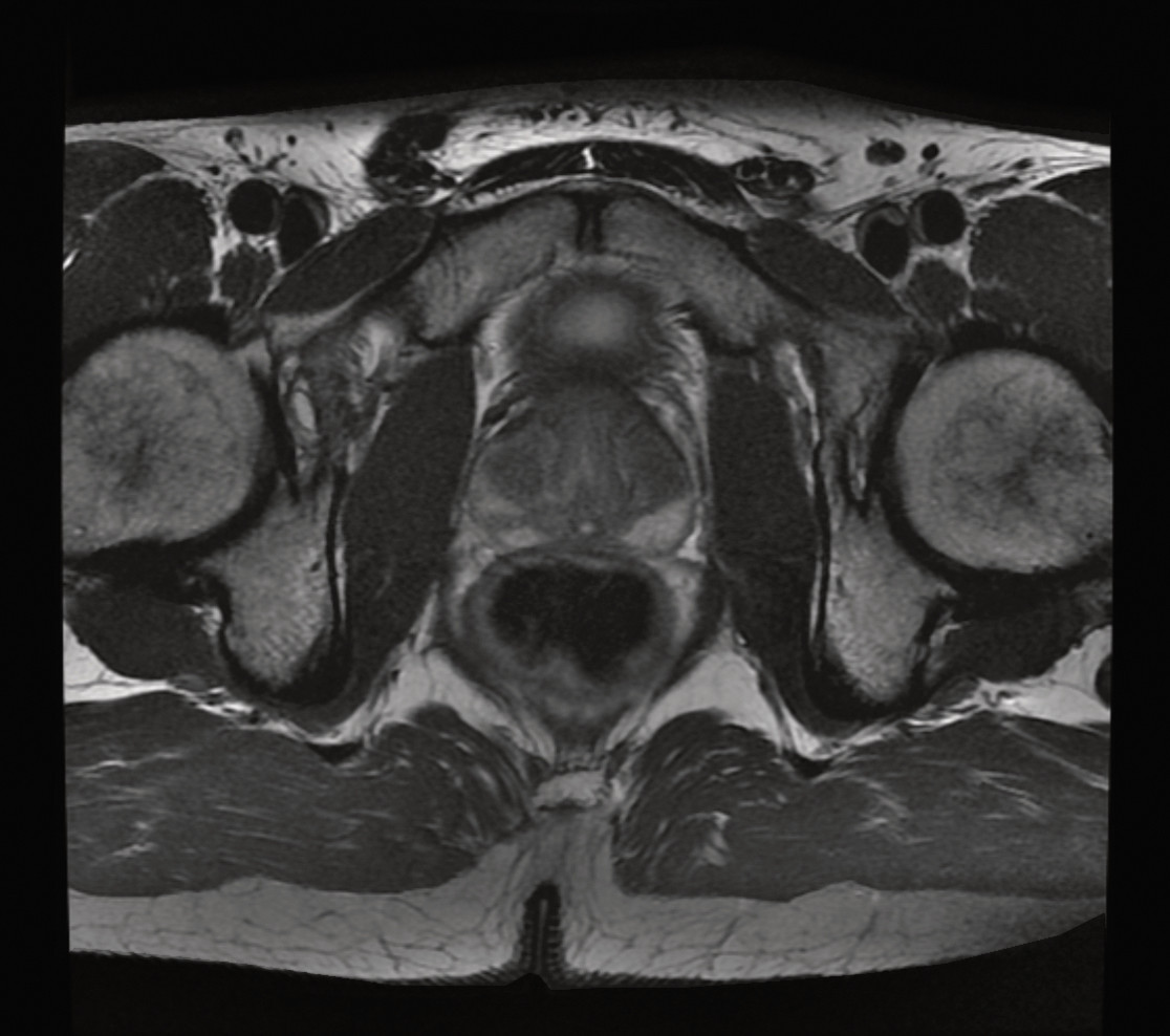 Prostate Mri Anatomy 7527