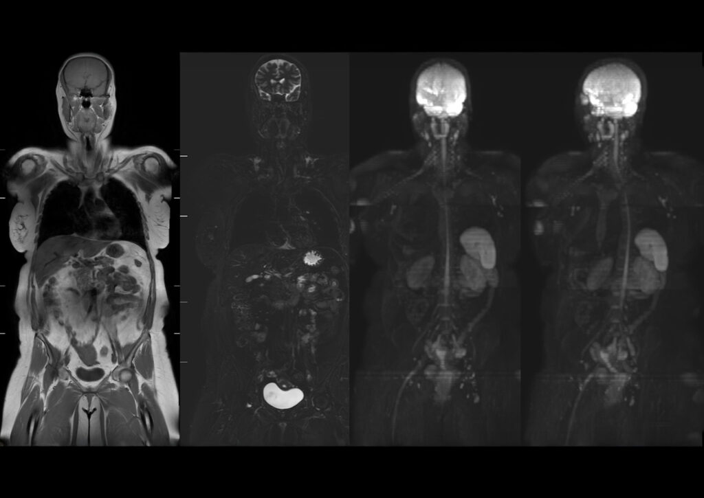 Whole-body MRI