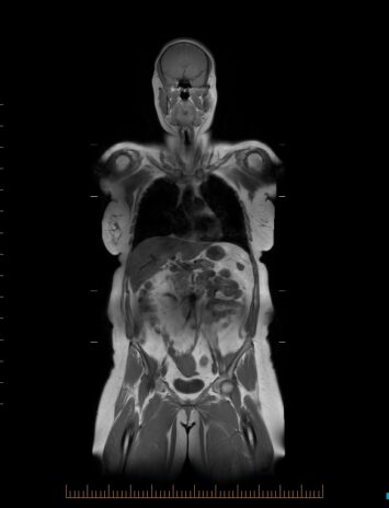 3. Whole Body T1 3. Whole Body T1